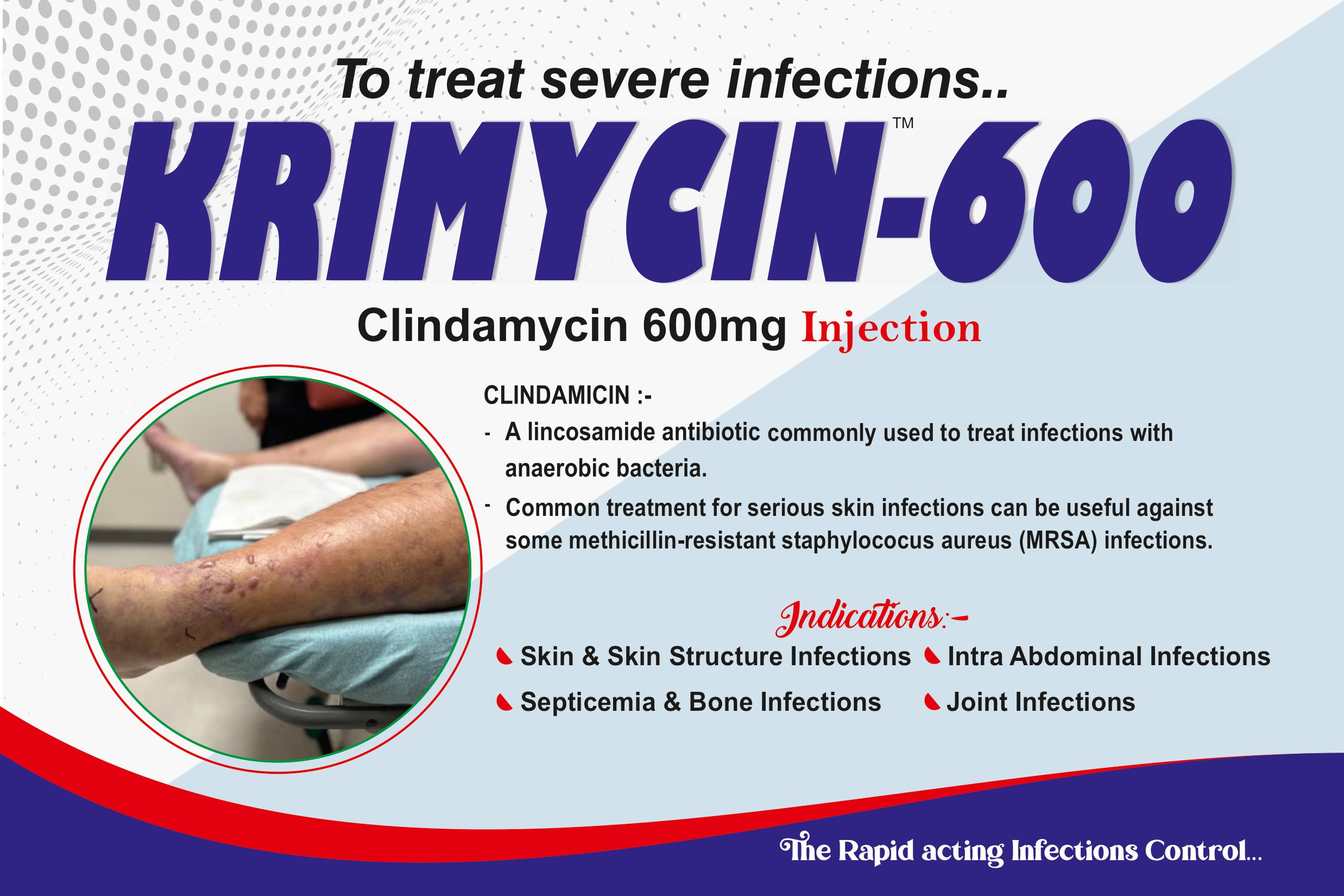 KRIMYCIN-600 Injection (Clindamycin 600 mg)